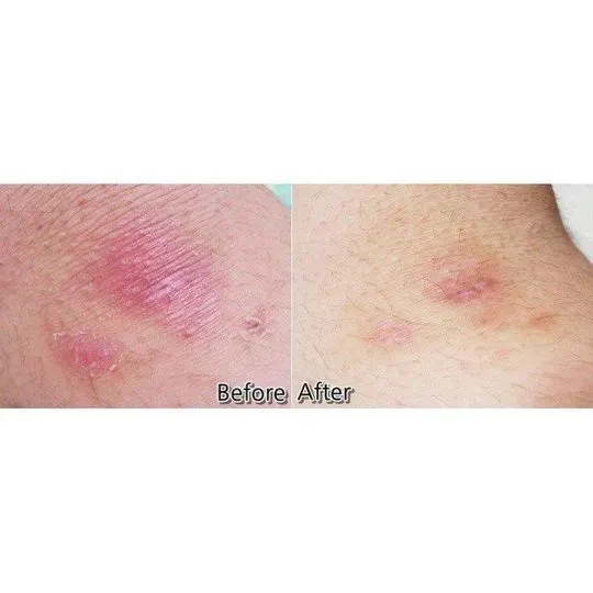 DONG A - Obat Jerawat Totol Cream Original Korea